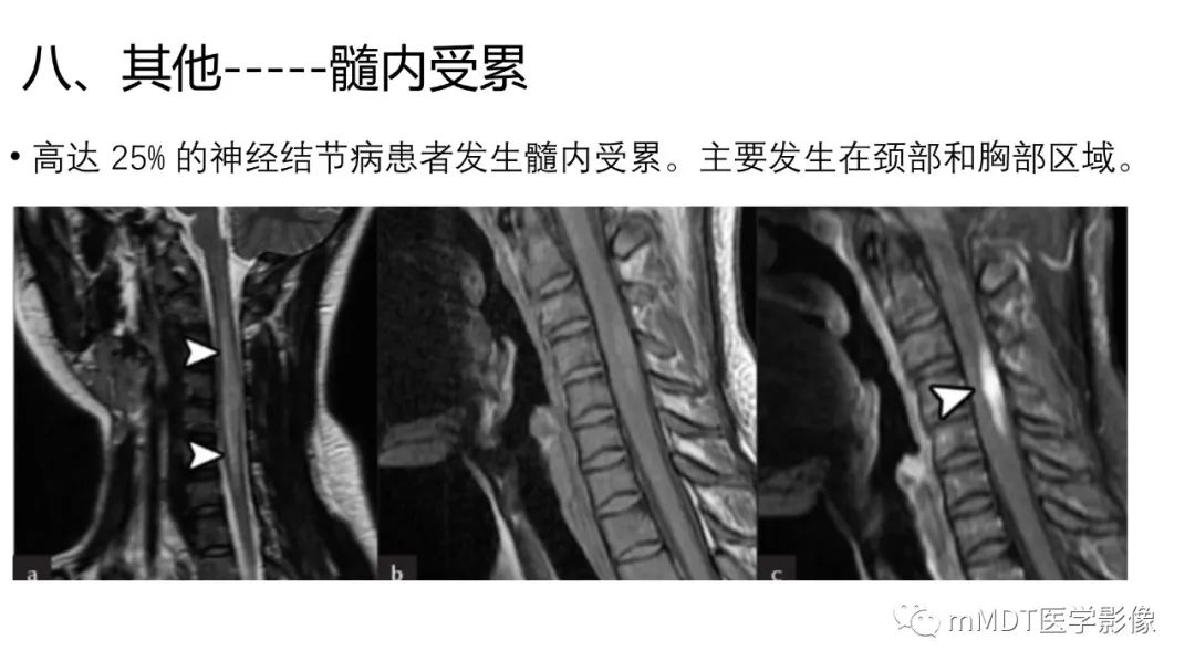 【PPT】双侧海绵窦结节病—神经结节病综述-38