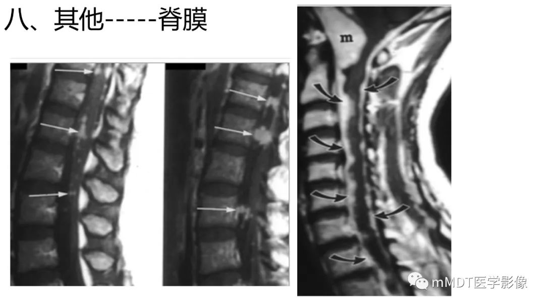 【PPT】双侧海绵窦结节病—神经结节病综述-40