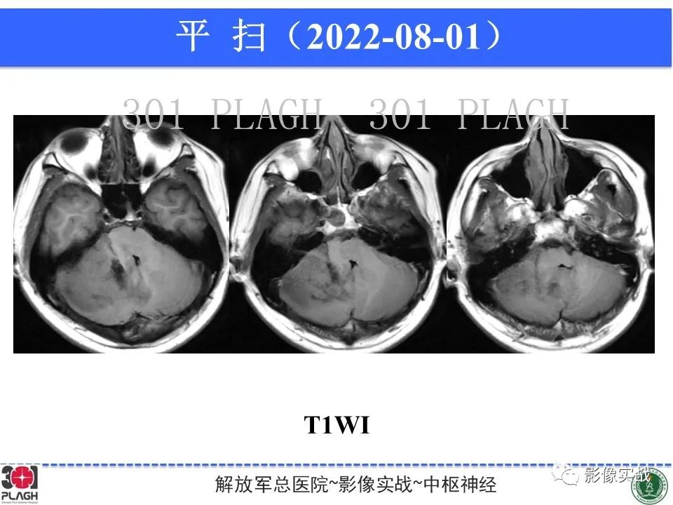 【病例】成人小脑髓母细胞瘤1例MR影像-5