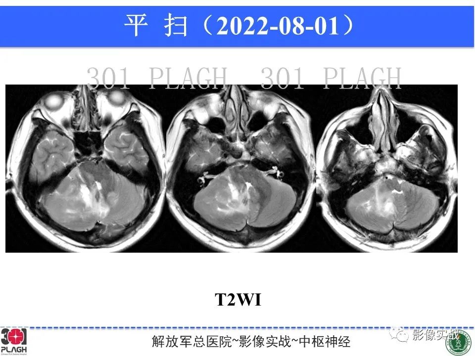 【病例】成人小脑髓母细胞瘤1例MR影像-4