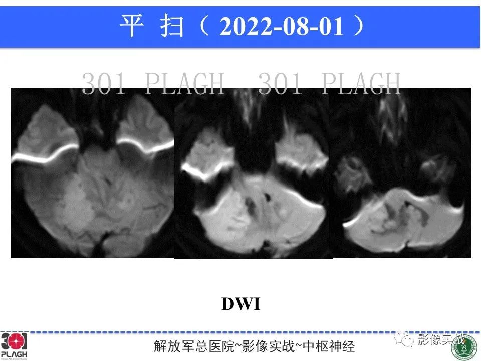 【病例】成人小脑髓母细胞瘤1例MR影像-6