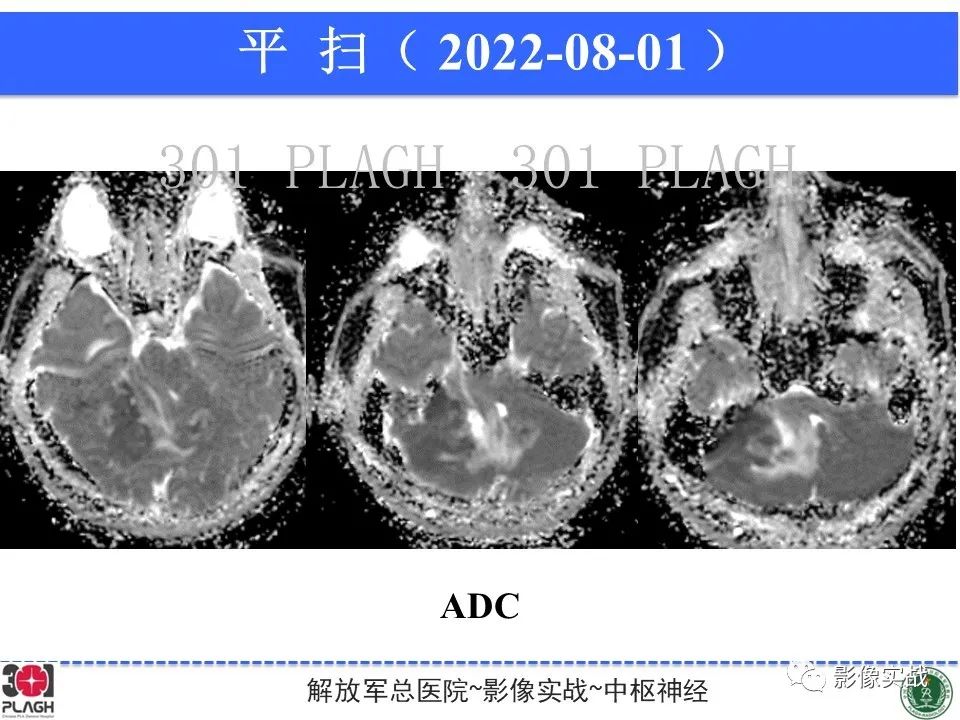 【病例】成人小脑髓母细胞瘤1例MR影像-7