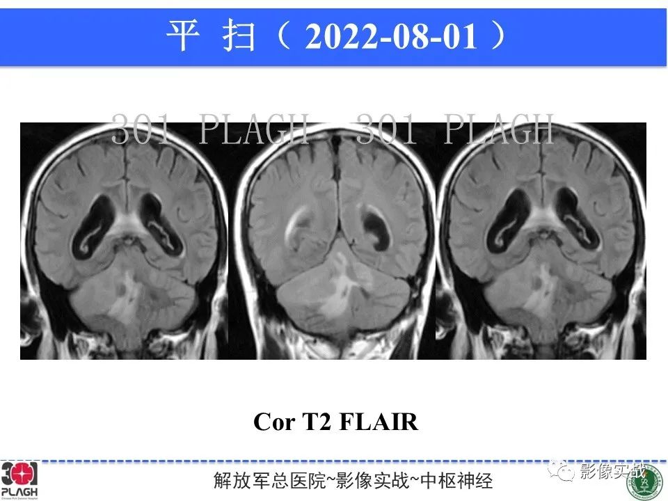 【病例】成人小脑髓母细胞瘤1例MR影像-8