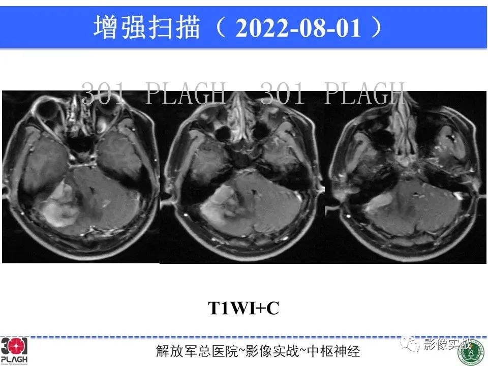 【病例】成人小脑髓母细胞瘤1例MR影像-9