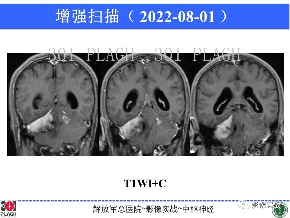 【病例】成人小脑髓母细胞瘤1例MR影像-10