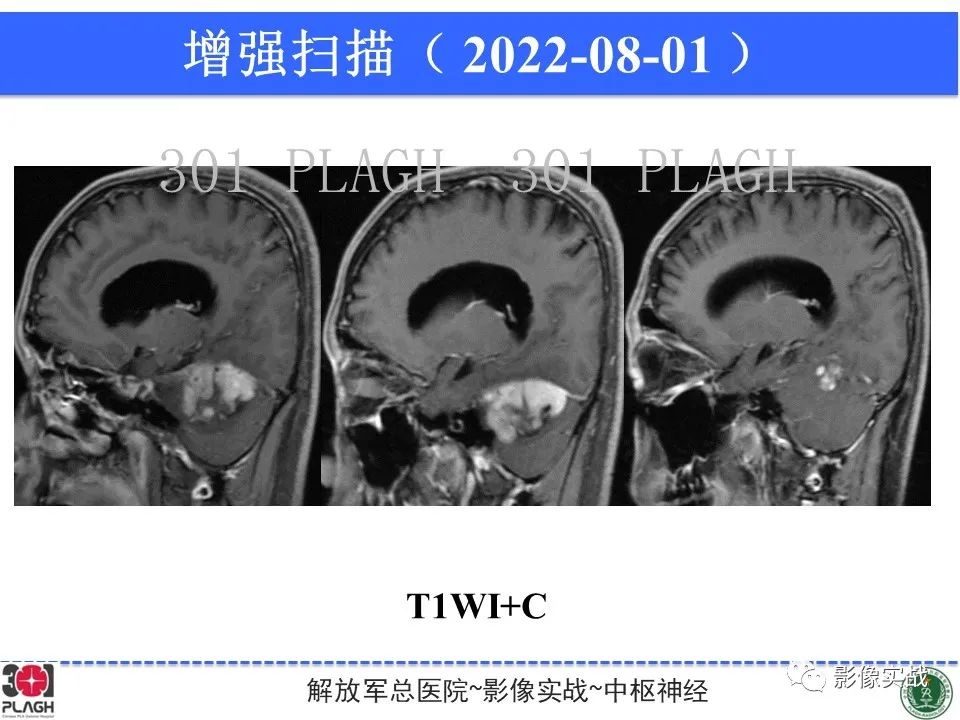 【病例】成人小脑髓母细胞瘤1例MR影像-11