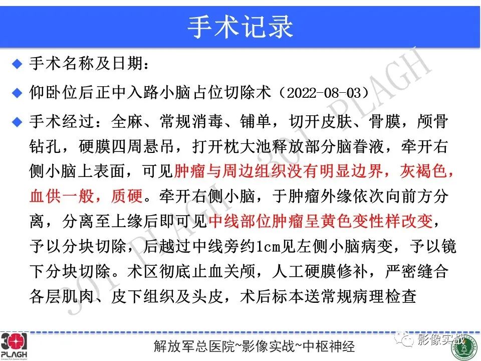 【病例】成人小脑髓母细胞瘤1例MR影像-18