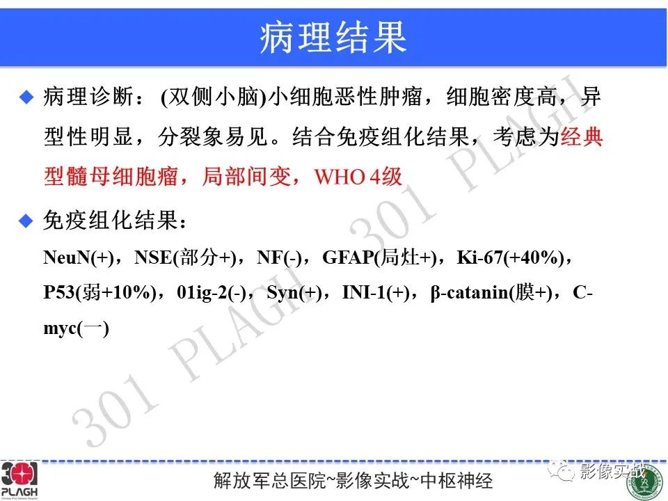 【病例】成人小脑髓母细胞瘤1例MR影像-19