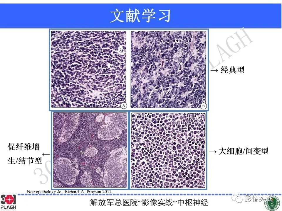 【病例】成人小脑髓母细胞瘤1例MR影像-22