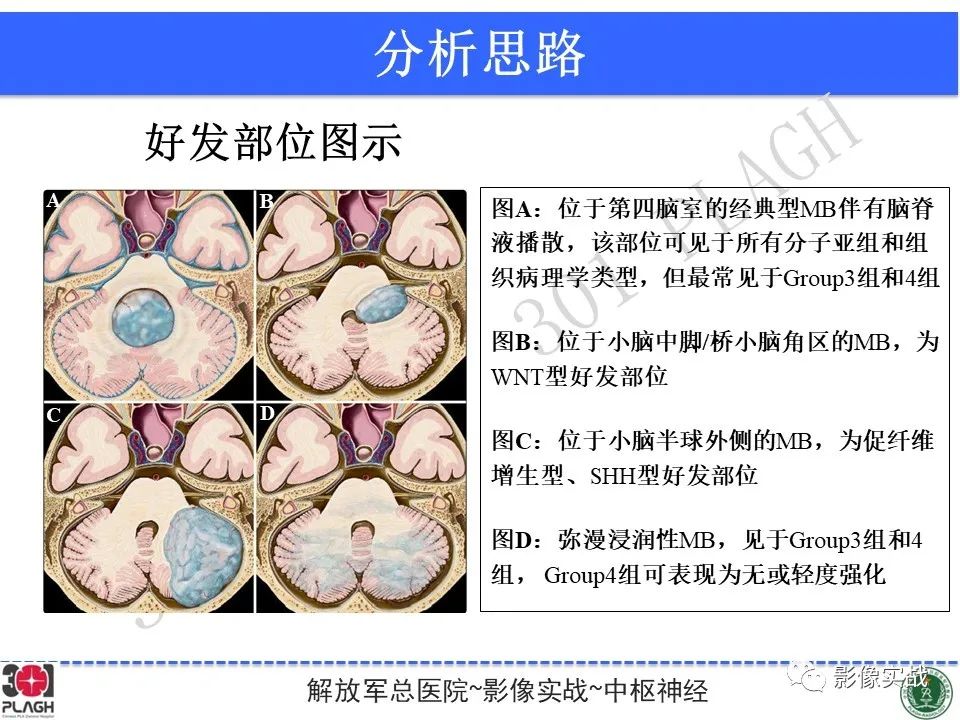 【病例】成人小脑髓母细胞瘤1例MR影像-24