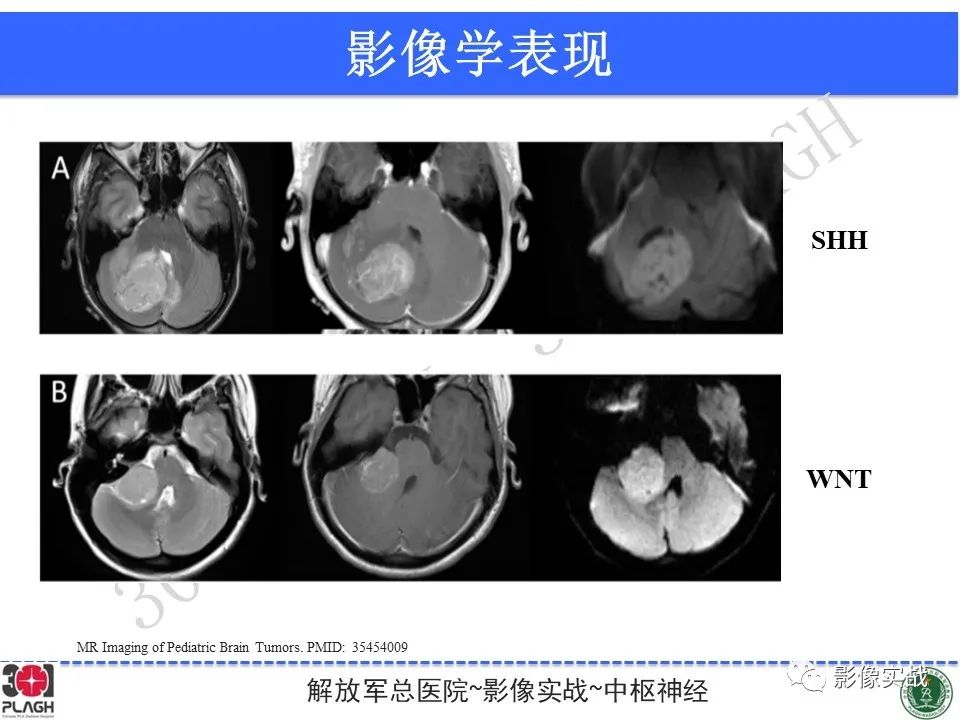 【病例】成人小脑髓母细胞瘤1例MR影像-26