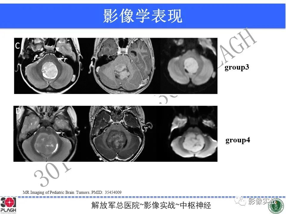 【病例】成人小脑髓母细胞瘤1例MR影像-27