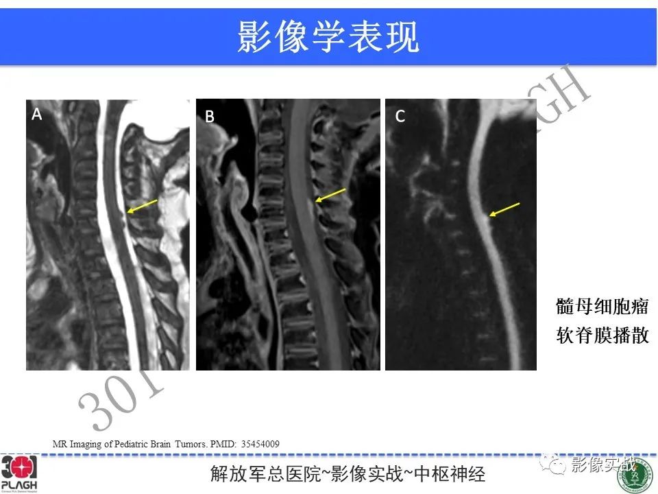 【病例】成人小脑髓母细胞瘤1例MR影像-28