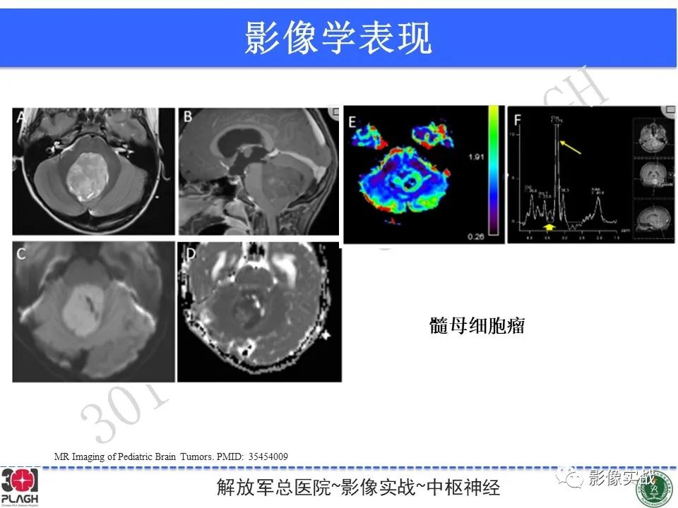 【病例】成人小脑髓母细胞瘤1例MR影像-29