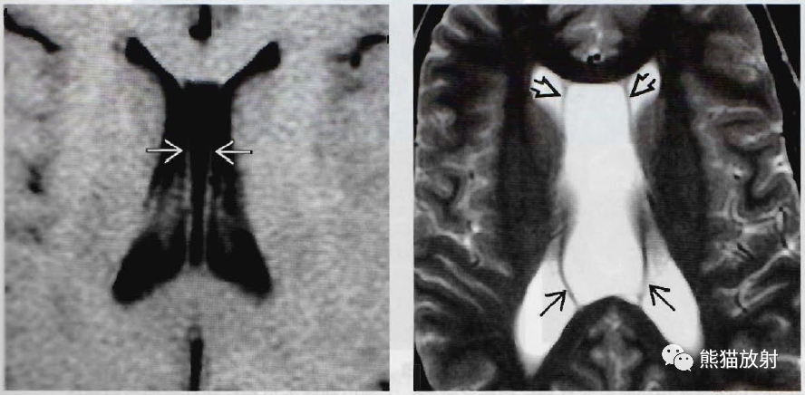 透明隔腔、中间帆腔影像诊断要点-2 透明隔腔、中间帆腔影像诊断要点-2