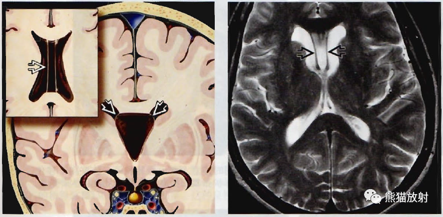 透明隔腔、中间帆腔影像诊断要点-1 透明隔腔、中间帆腔影像诊断要点-1