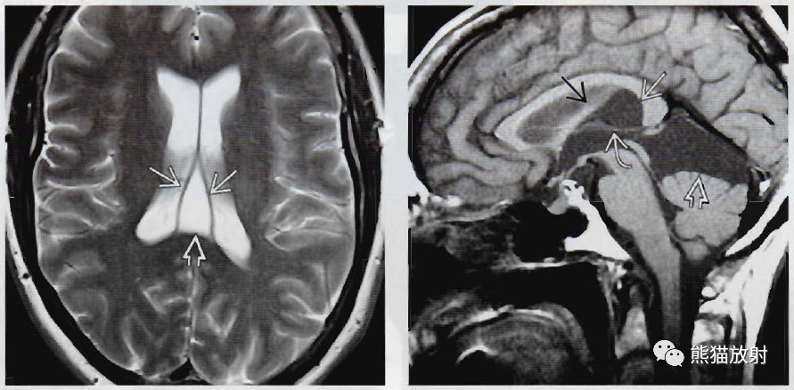 透明隔腔、中间帆腔影像诊断要点-4 透明隔腔、中间帆腔影像诊断要点-4