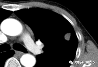 结核肉芽肿性病变—结核瘤及纤维干酪结节-3