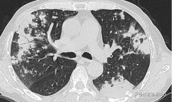 结核肉芽肿性病变—结核瘤及纤维干酪结节-5