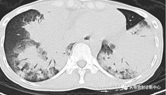 结核肉芽肿性病变—结核瘤及纤维干酪结节-2
