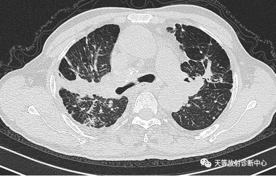 结核肉芽肿性病变—结核瘤及纤维干酪结节-1