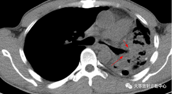 结核肉芽肿性病变—结核瘤及纤维干酪结节-4