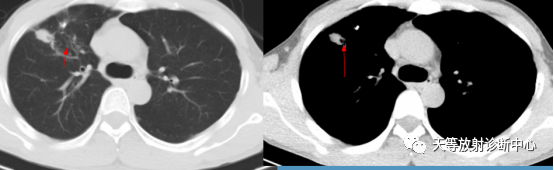 结核肉芽肿性病变—结核瘤及纤维干酪结节-6