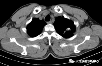 结核肉芽肿性病变—结核瘤及纤维干酪结节-7