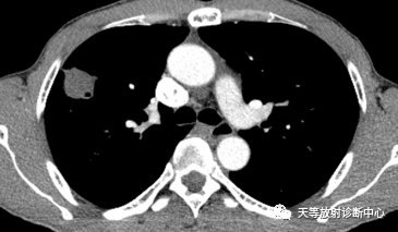 结核肉芽肿性病变—结核瘤及纤维干酪结节-8