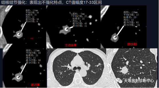 结核肉芽肿性病变—结核瘤及纤维干酪结节-9