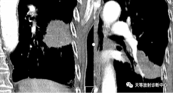 结核肉芽肿性病变—结核瘤及纤维干酪结节-10