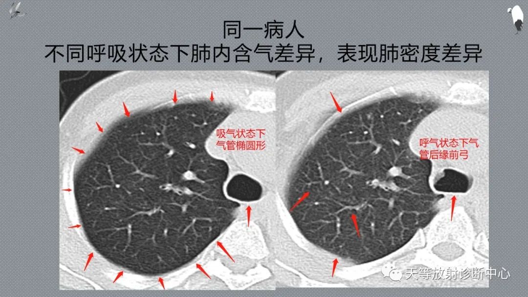 正常吸气及呼气HRCT表现—探索小叶性含气增多影像学-3