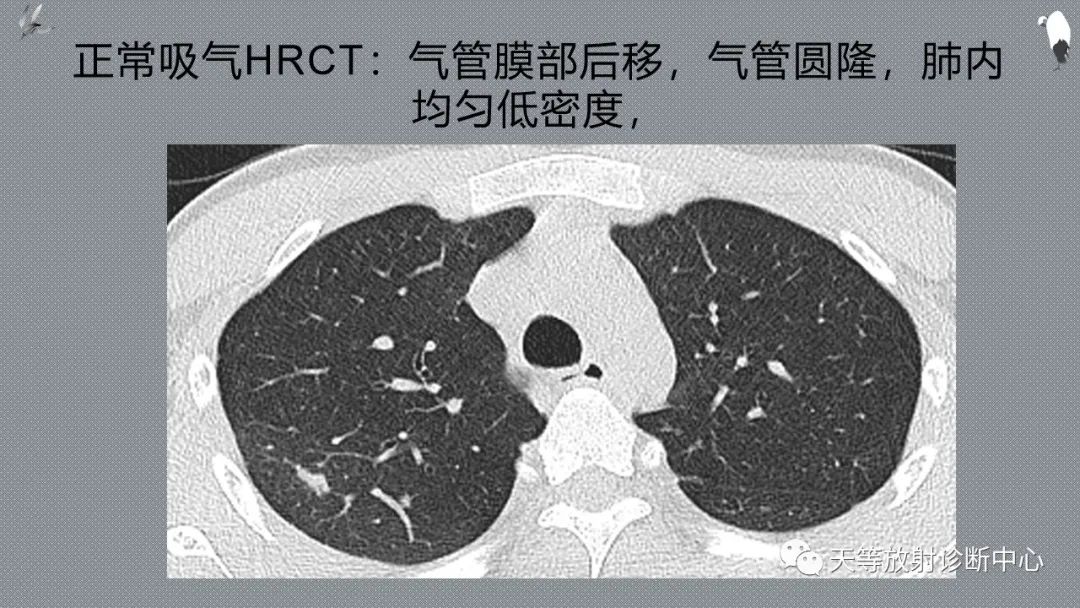 正常吸气及呼气HRCT表现—探索小叶性含气增多影像学-6