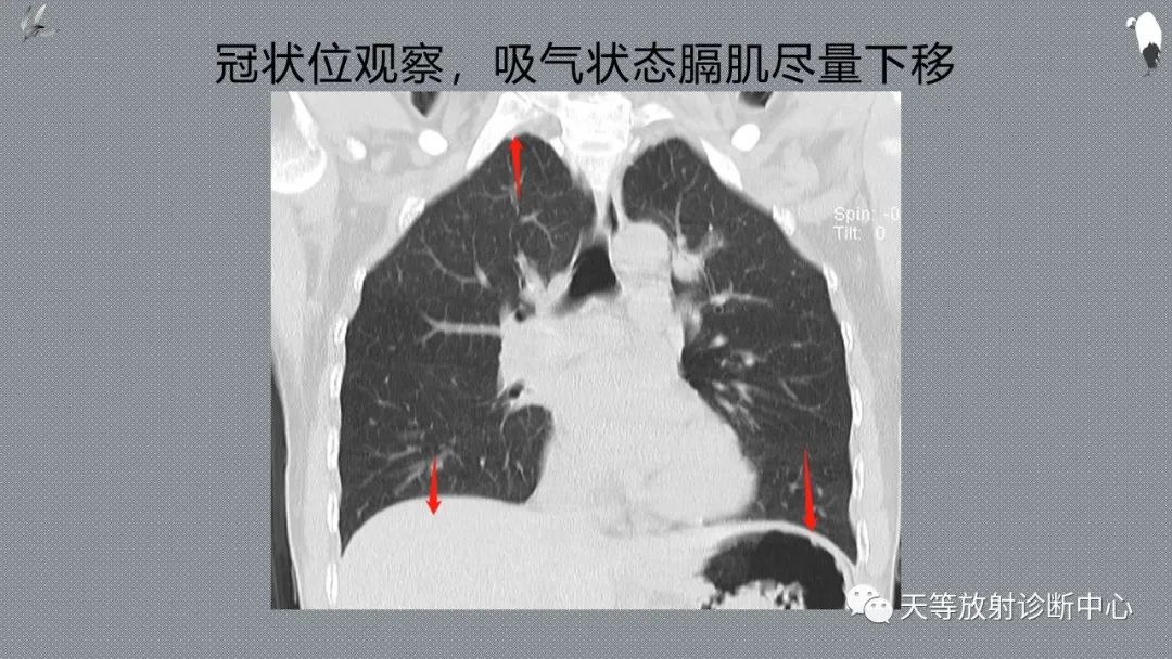 正常吸气及呼气HRCT表现—探索小叶性含气增多影像学-7