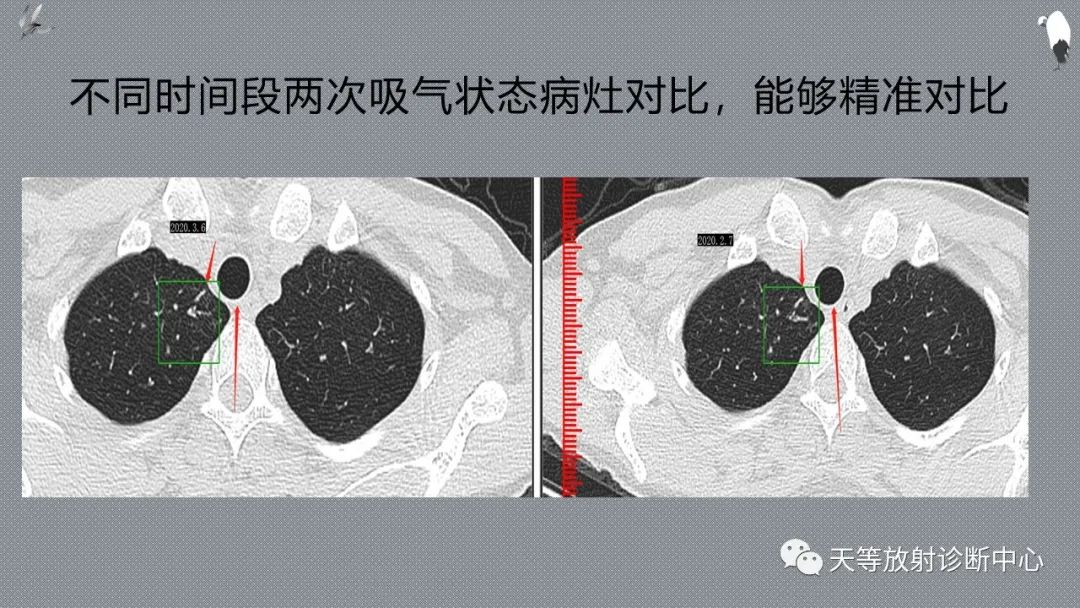 正常吸气及呼气HRCT表现—探索小叶性含气增多影像学-8