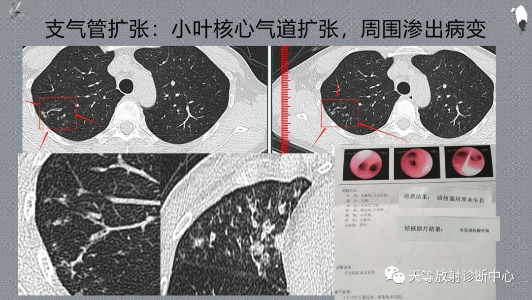 正常吸气及呼气HRCT表现—探索小叶性含气增多影像学-9