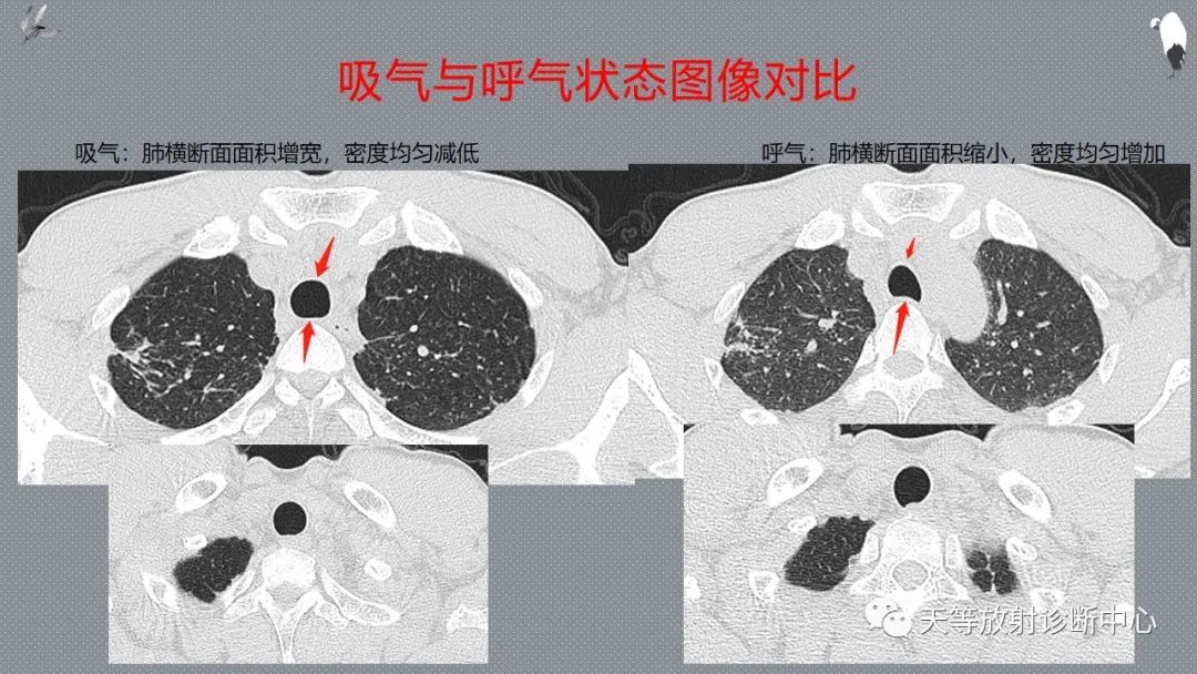 正常吸气及呼气HRCT表现—探索小叶性含气增多影像学-12