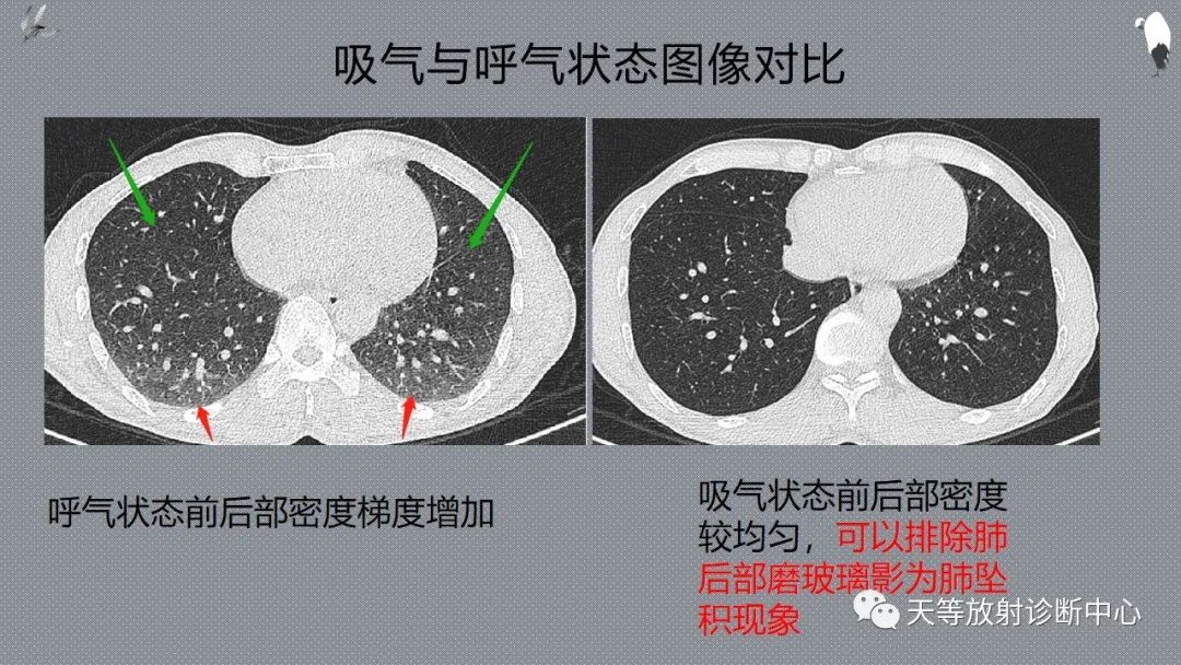 正常吸气及呼气HRCT表现—探索小叶性含气增多影像学-13