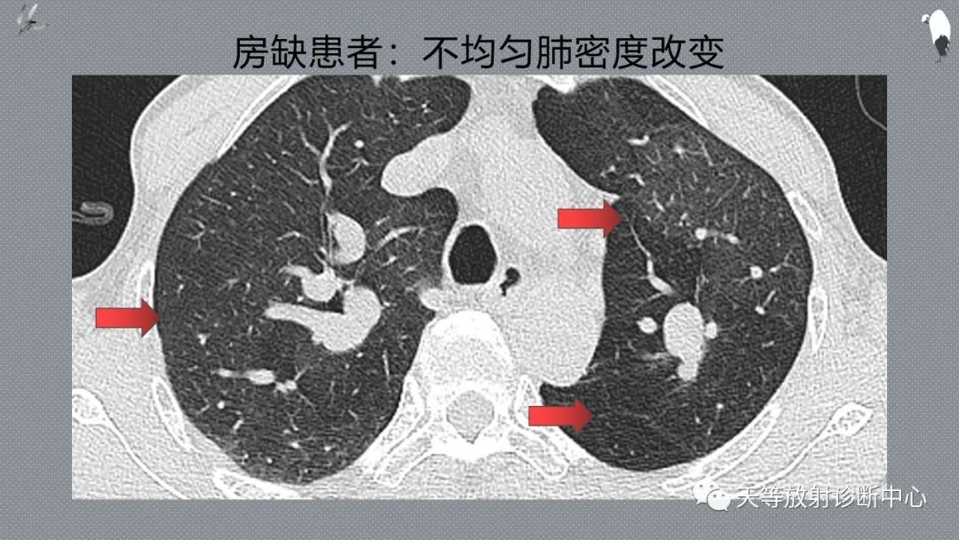 正常吸气及呼气HRCT表现—探索小叶性含气增多影像学-16