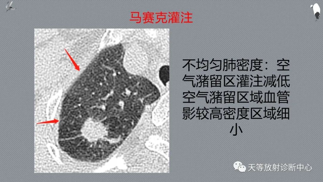 正常吸气及呼气HRCT表现—探索小叶性含气增多影像学-15
