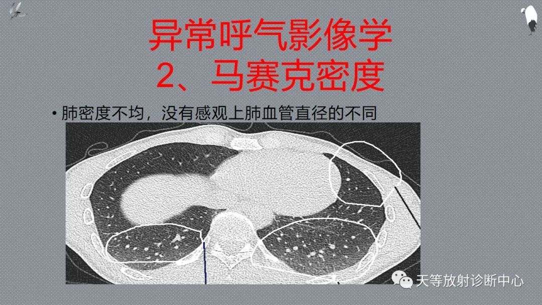 正常吸气及呼气HRCT表现—探索小叶性含气增多影像学-17