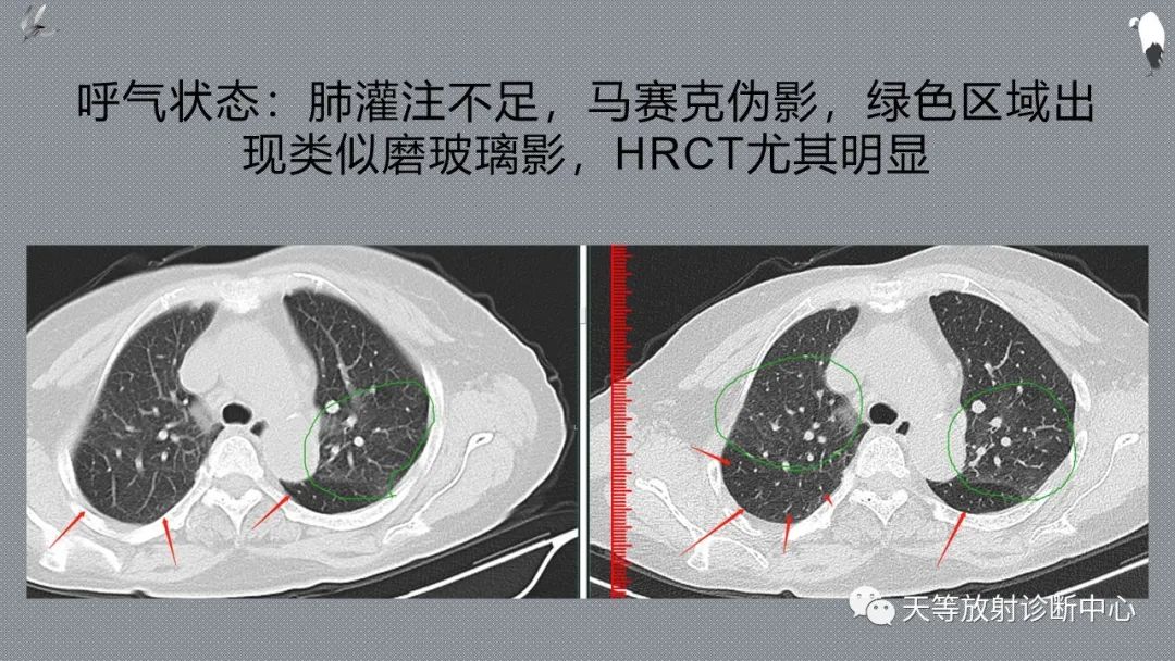 正常吸气及呼气HRCT表现—探索小叶性含气增多影像学-19