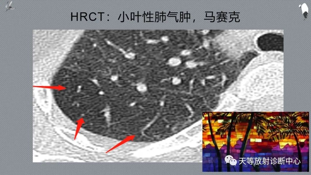 正常吸气及呼气HRCT表现—探索小叶性含气增多影像学-20