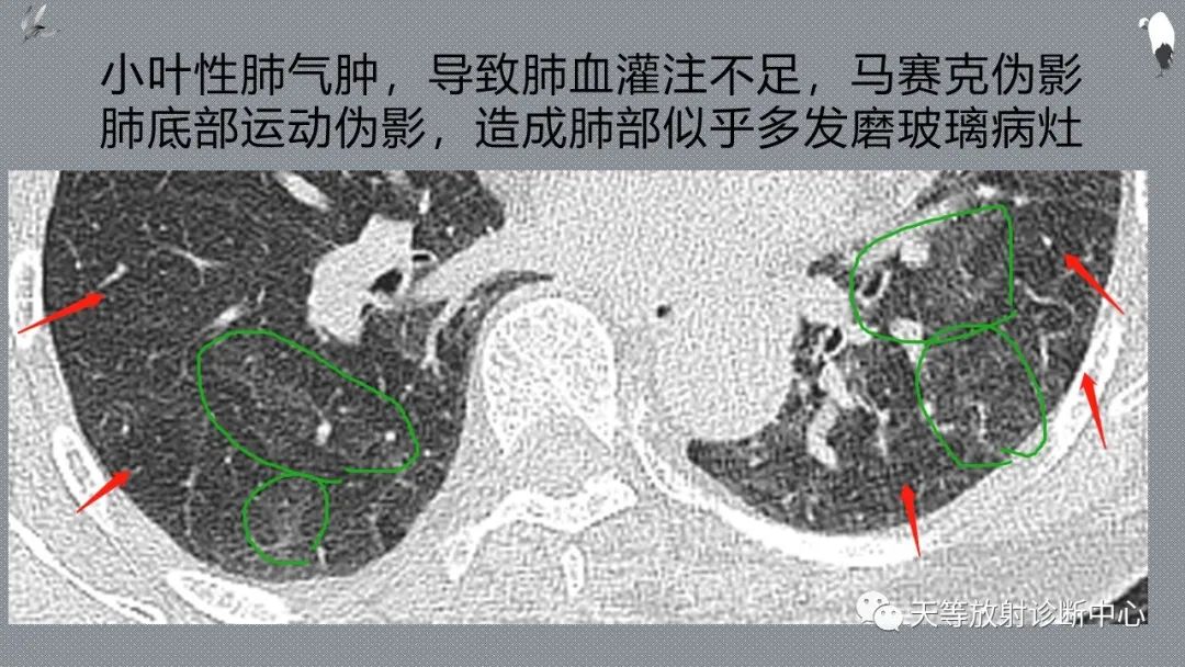 正常吸气及呼气HRCT表现—探索小叶性含气增多影像学-21