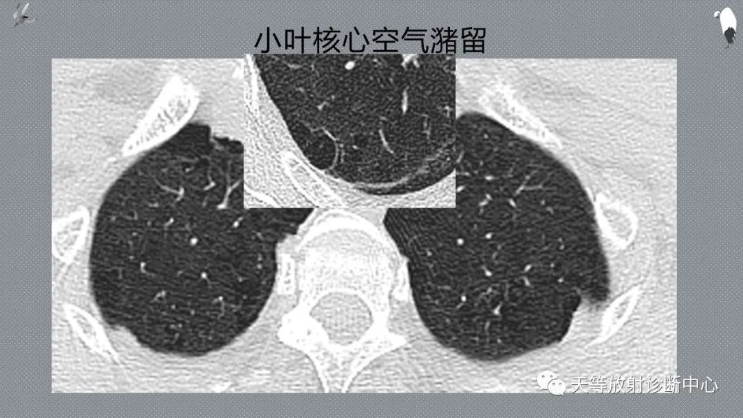 正常吸气及呼气HRCT表现—探索小叶性含气增多影像学-24