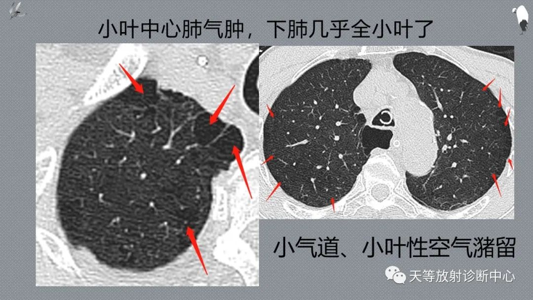 正常吸气及呼气HRCT表现—探索小叶性含气增多影像学-25