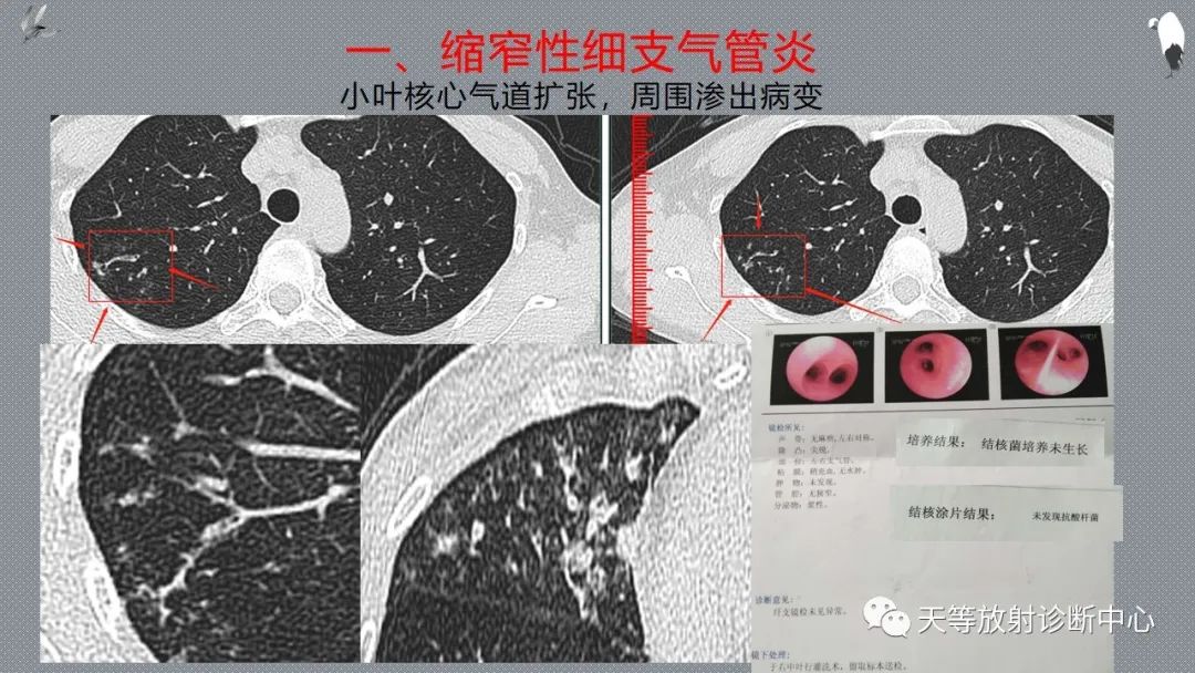 正常吸气及呼气HRCT表现—探索小叶性含气增多影像学-26