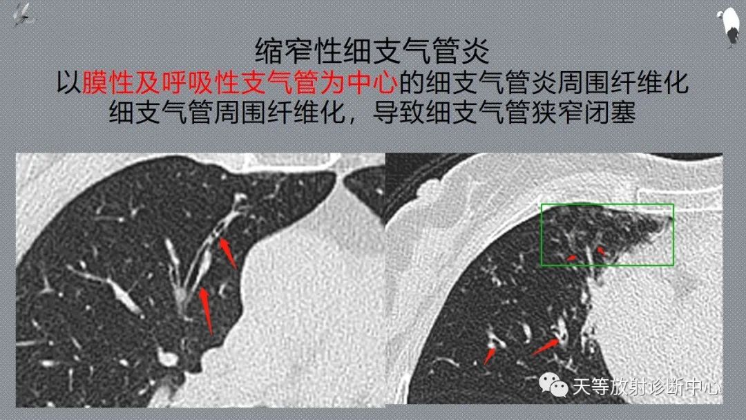 正常吸气及呼气HRCT表现—探索小叶性含气增多影像学-27