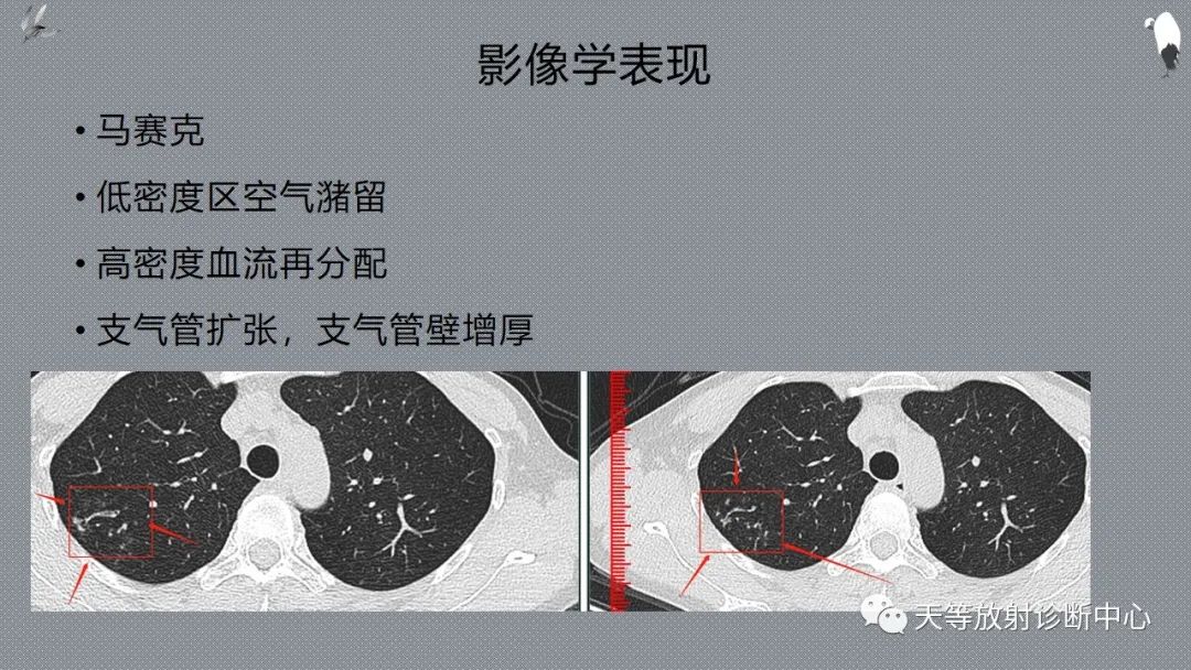 正常吸气及呼气HRCT表现—探索小叶性含气增多影像学-28