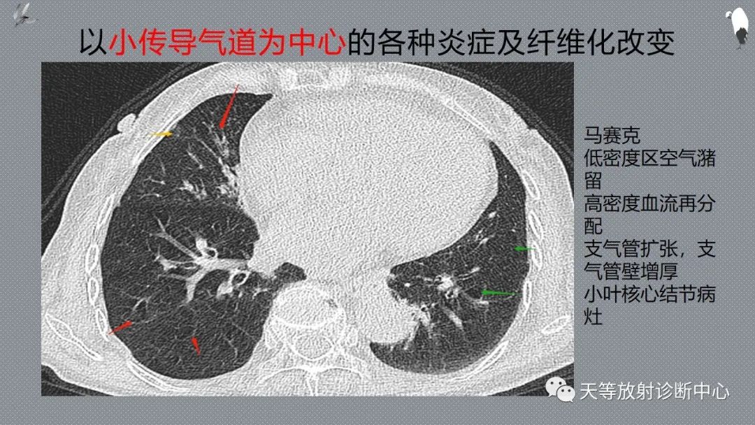 正常吸气及呼气HRCT表现—探索小叶性含气增多影像学-30